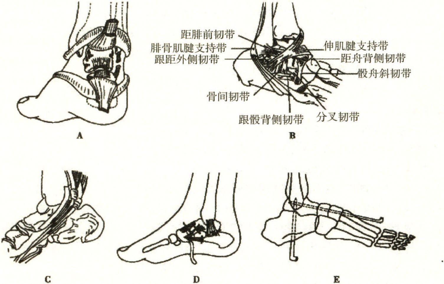 二、馬蹄內(nèi)翻足的治療